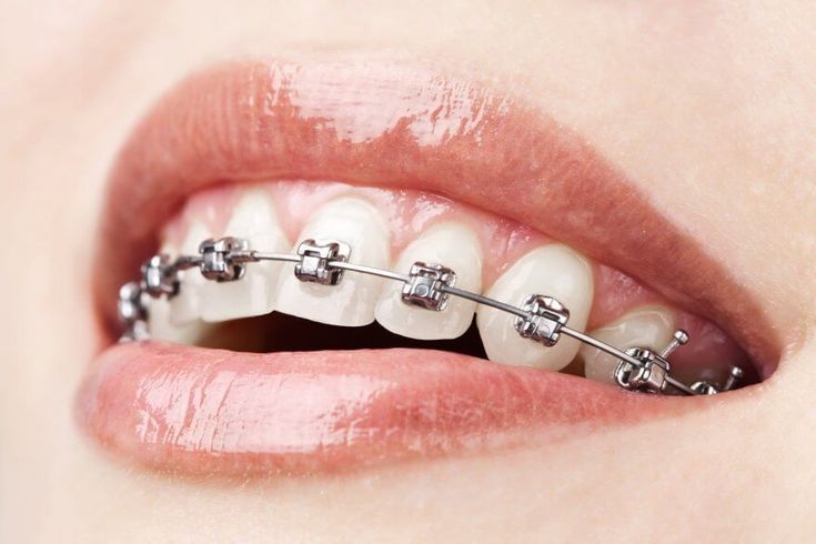 Braces (Fix Ortho)