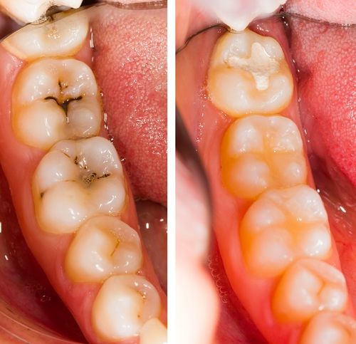Filling / Restoration