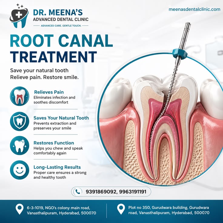 RCT (Root Canal Treatment)