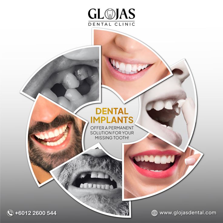Dental Implant